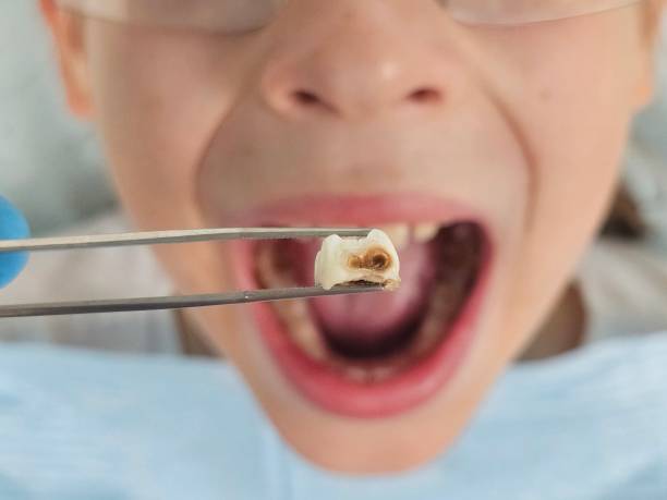 Best Emergency Wisdom Teeth Removal in White Knoll, SC