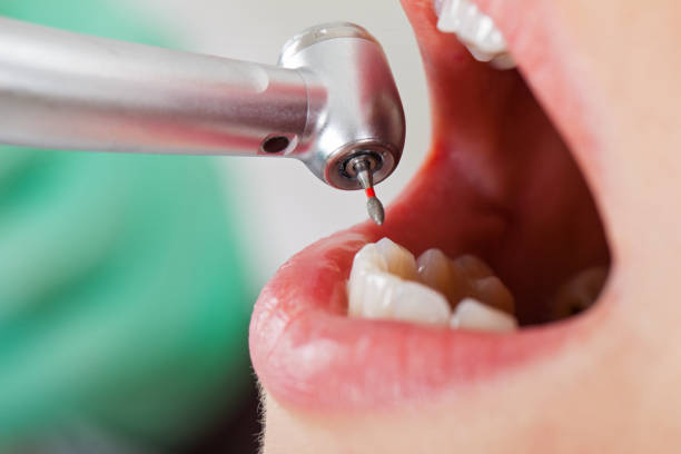 Best Emergency Tooth Extraction in White Knoll, SC